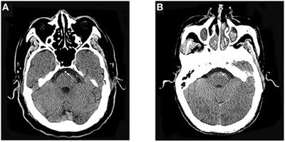 Hyperdense Artery Sign and Clinical Outcomes After Endovascular Treatment in Acute Basilar Artery Occlusion